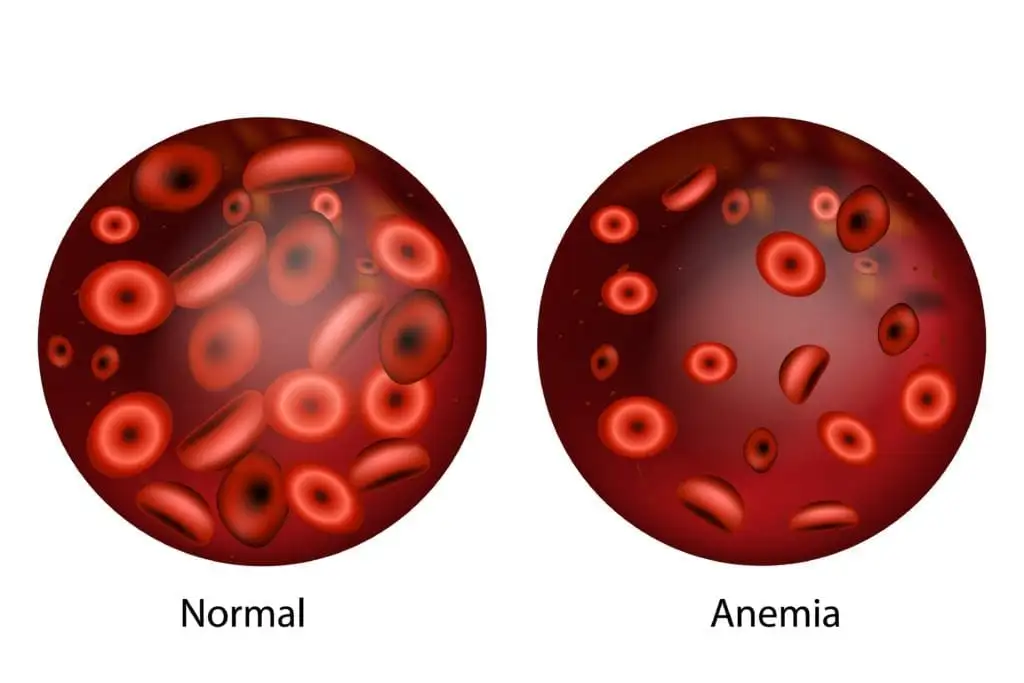 one normal blood sample and one sample with anemia