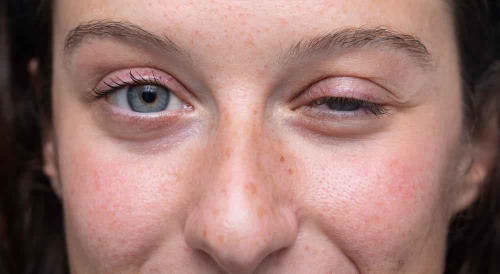 woman with dropping eyelid