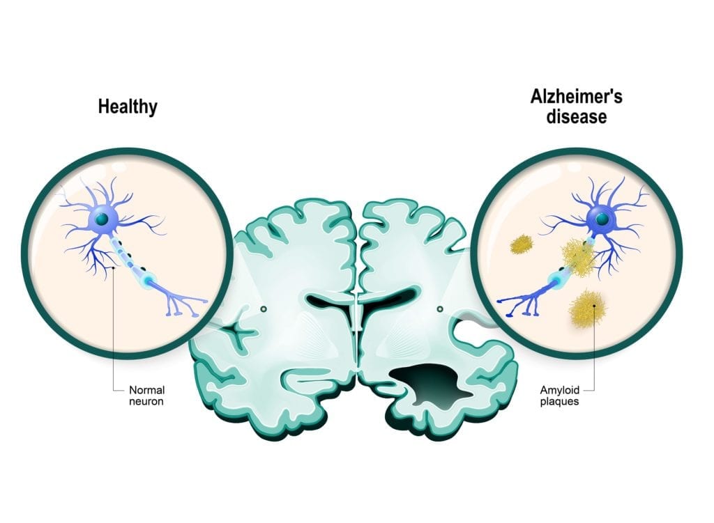 Alzheimer’s Disease