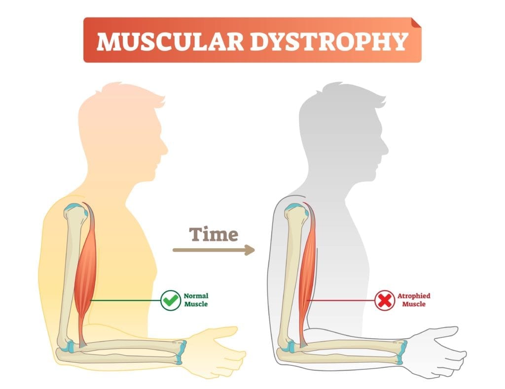 diagram showing muscle atrophy associated with muscular dystrophy