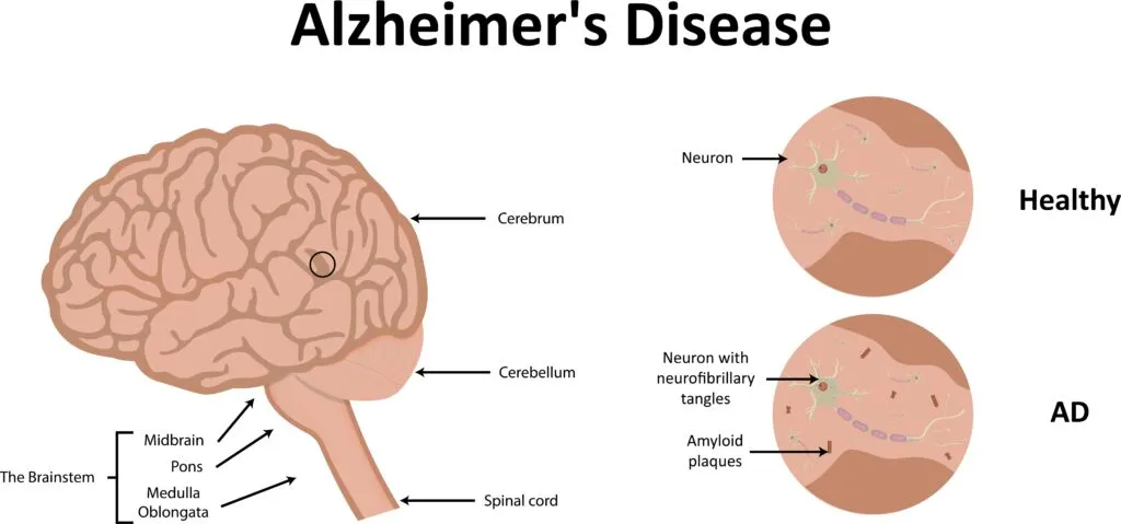 how alzheimer's affects the brain
