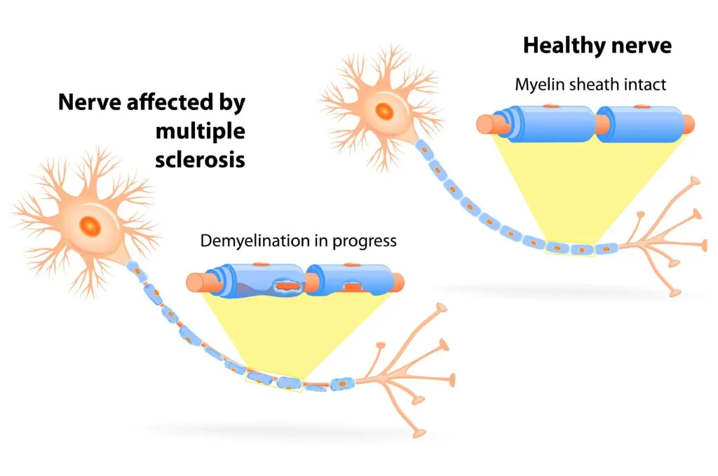 healthy nerve vs nerve affected by demyelination