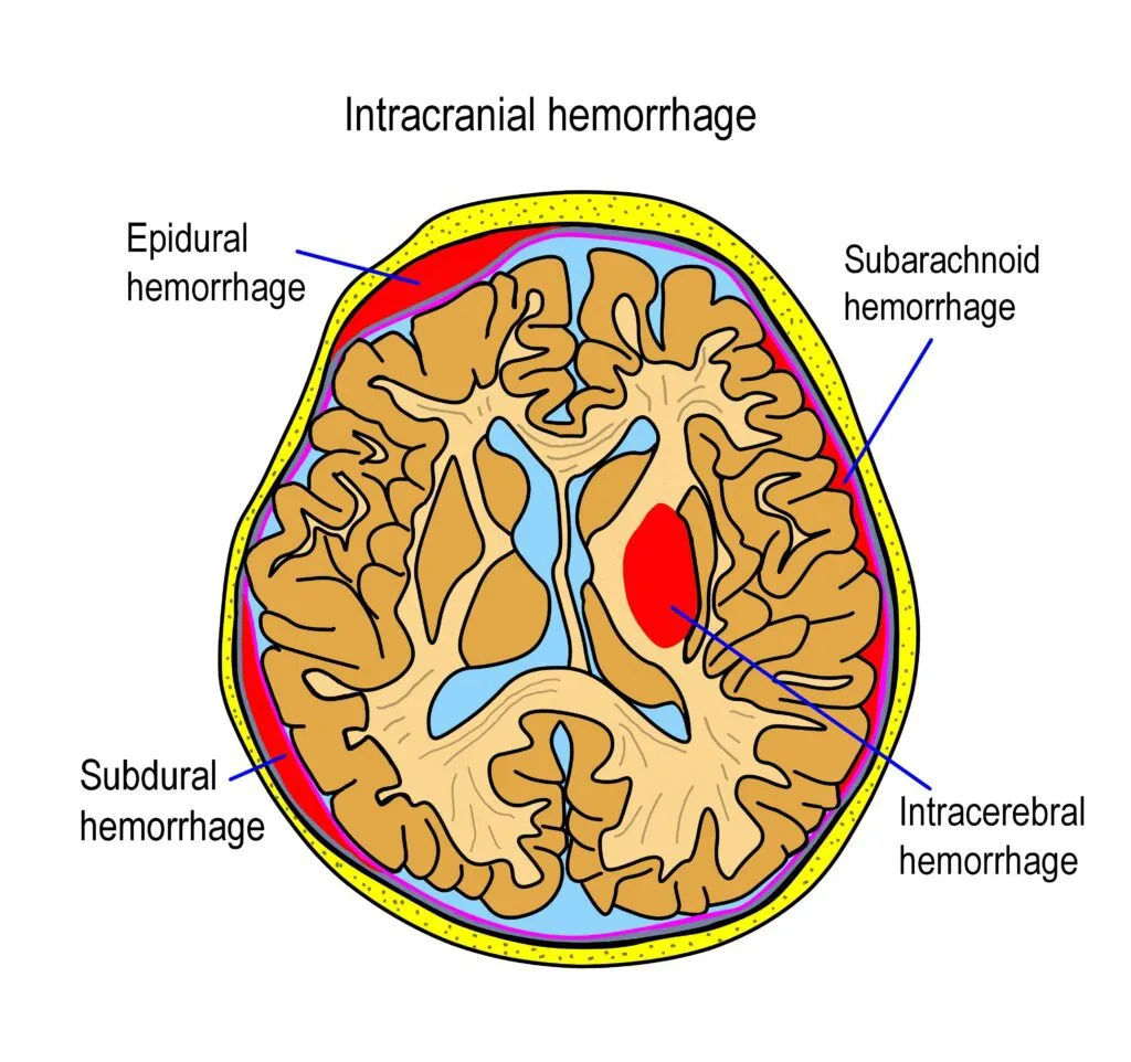 types of intracranial hemorrhage