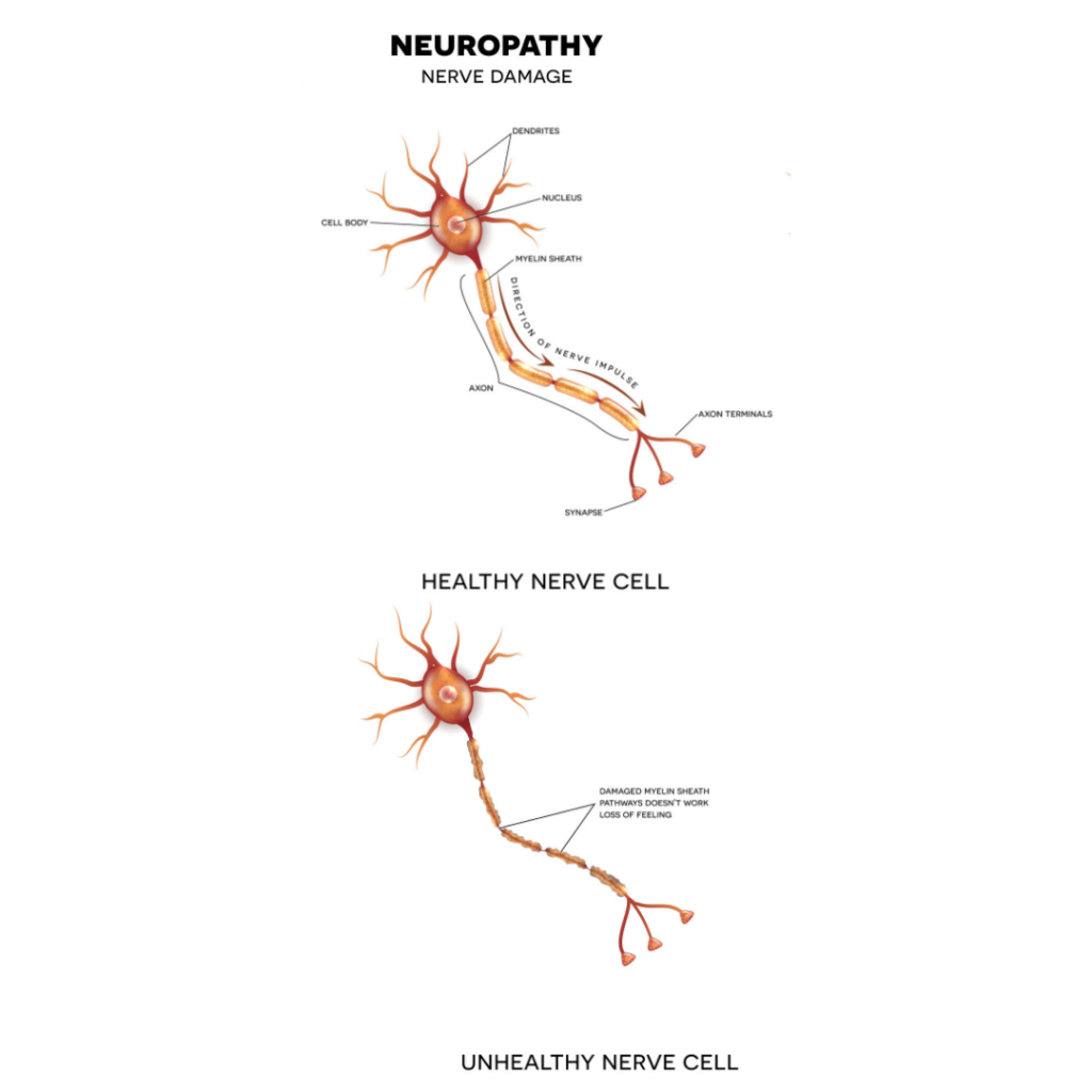 healthy nerve vs damaged nerve