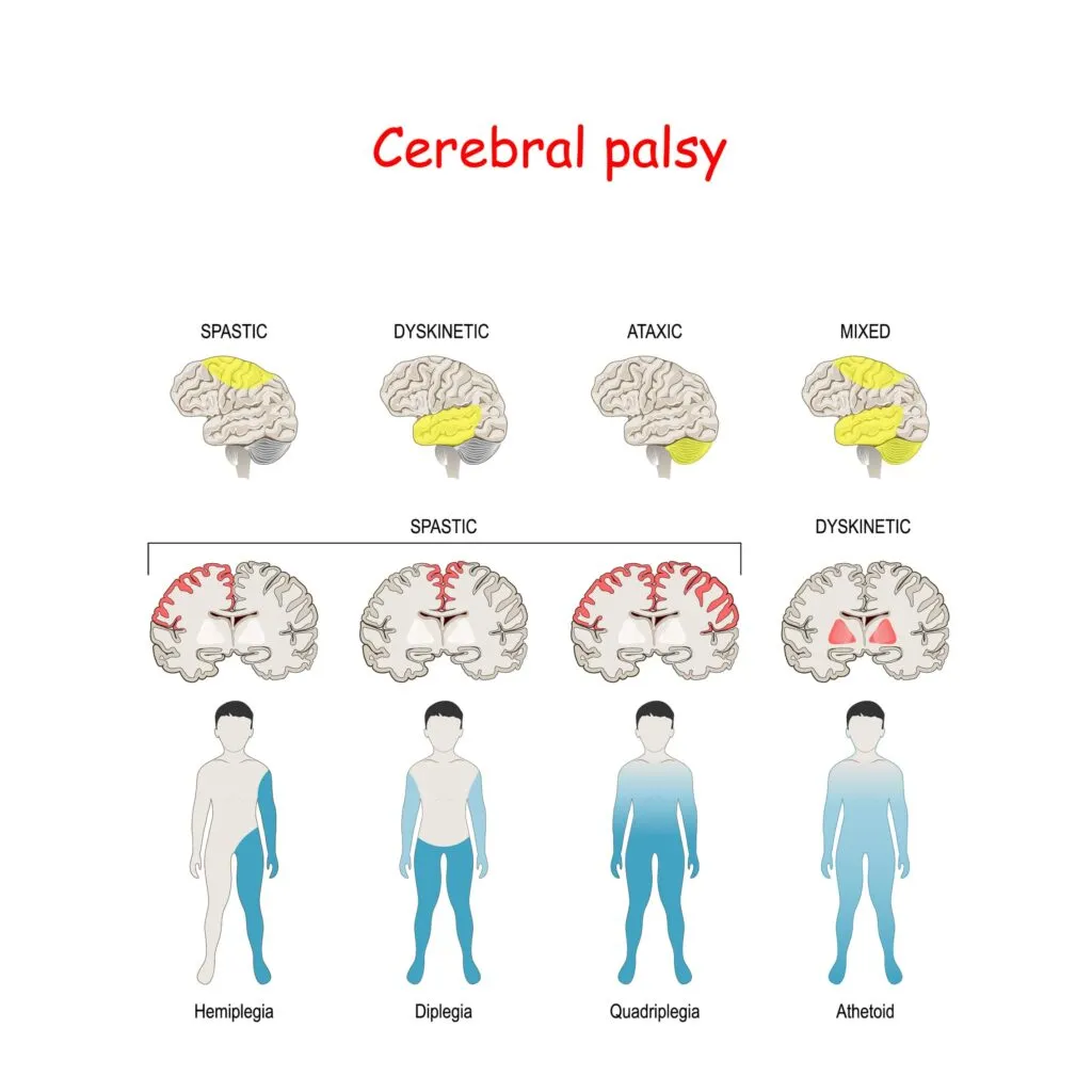 types of cerebral palsy