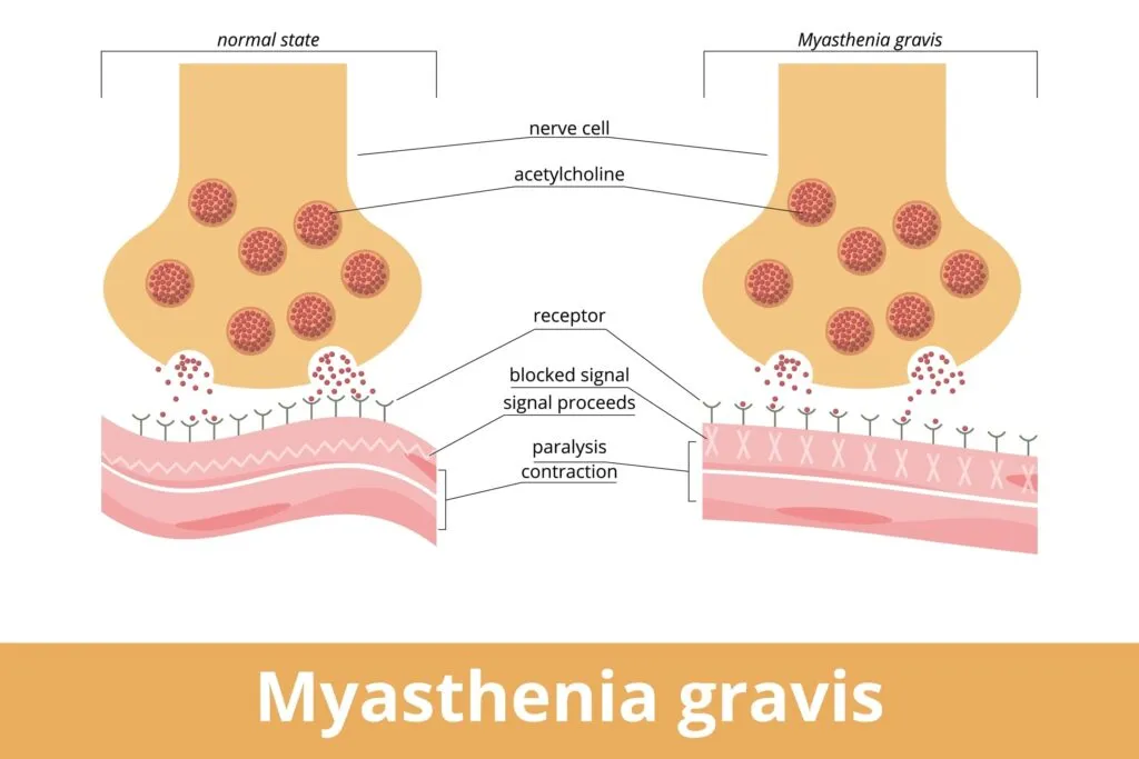 Managing Myasthenia Gravis: Neurological Treatments and Lifestyle Adjustments