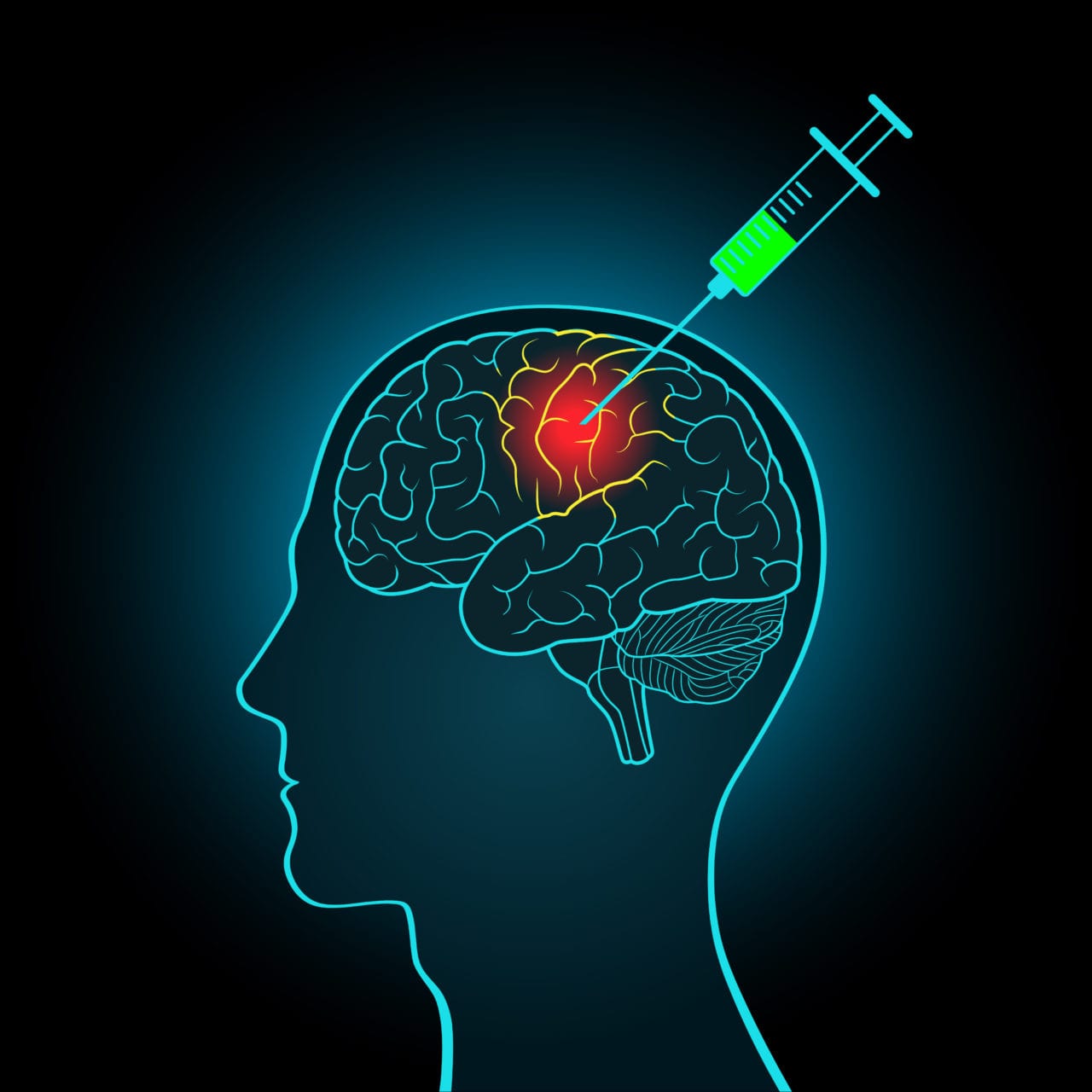 Botox for Migraine - Premier Neurology & Wellness Center