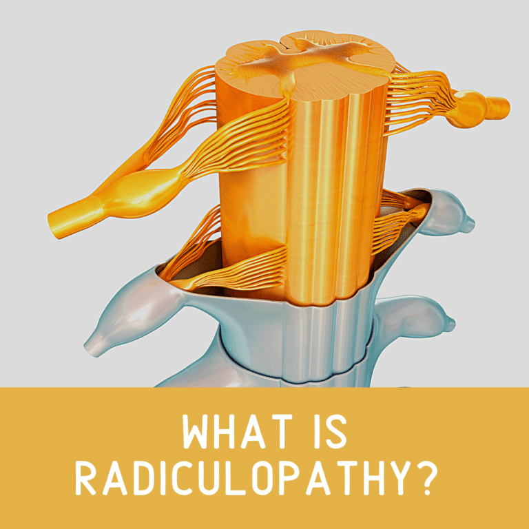 What is Radiculopathy