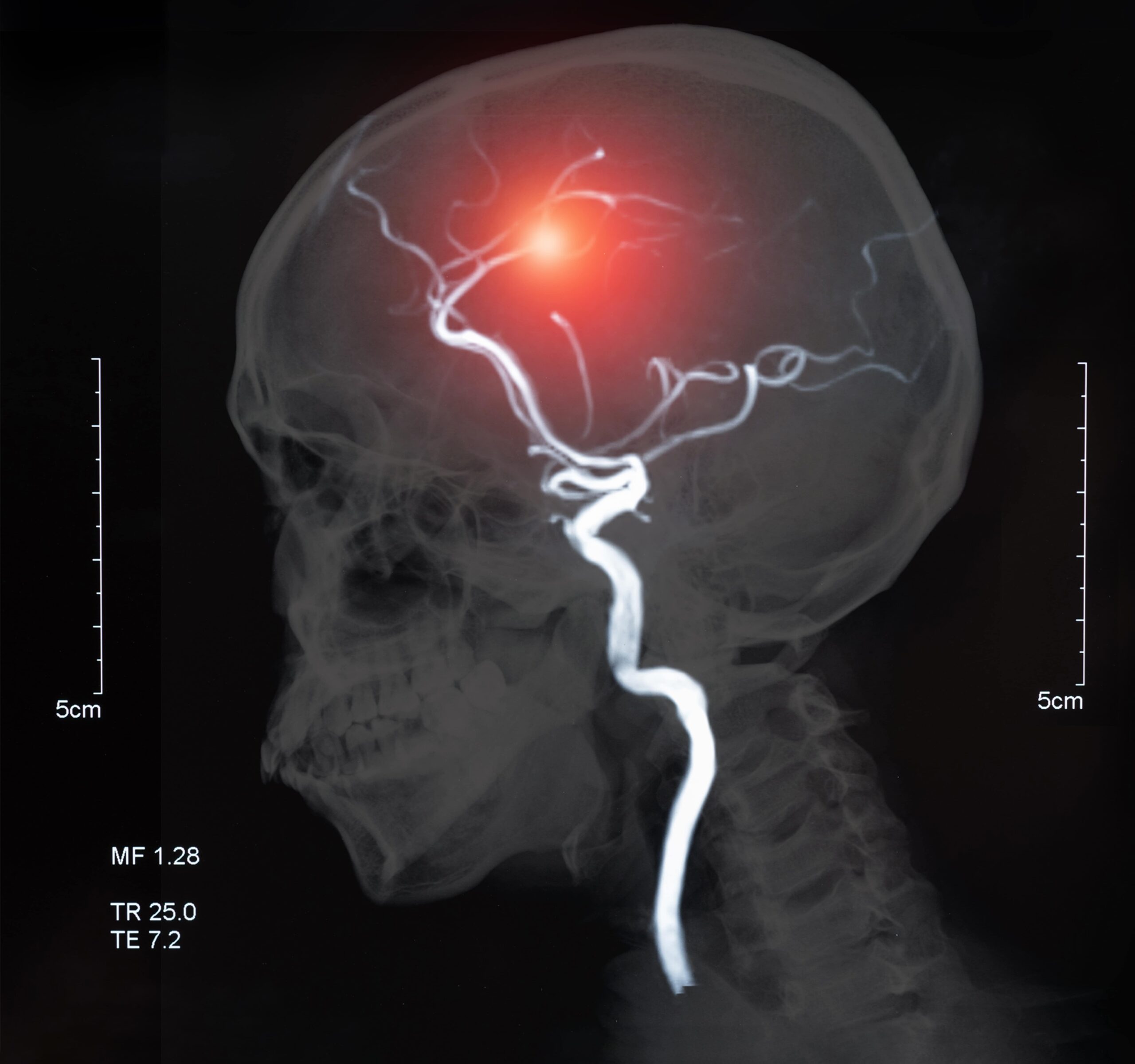 MRI of the blood vessels in the brain and cerebrovascular disease or or hemorrhagic stroke. brain stroke x-ray image.