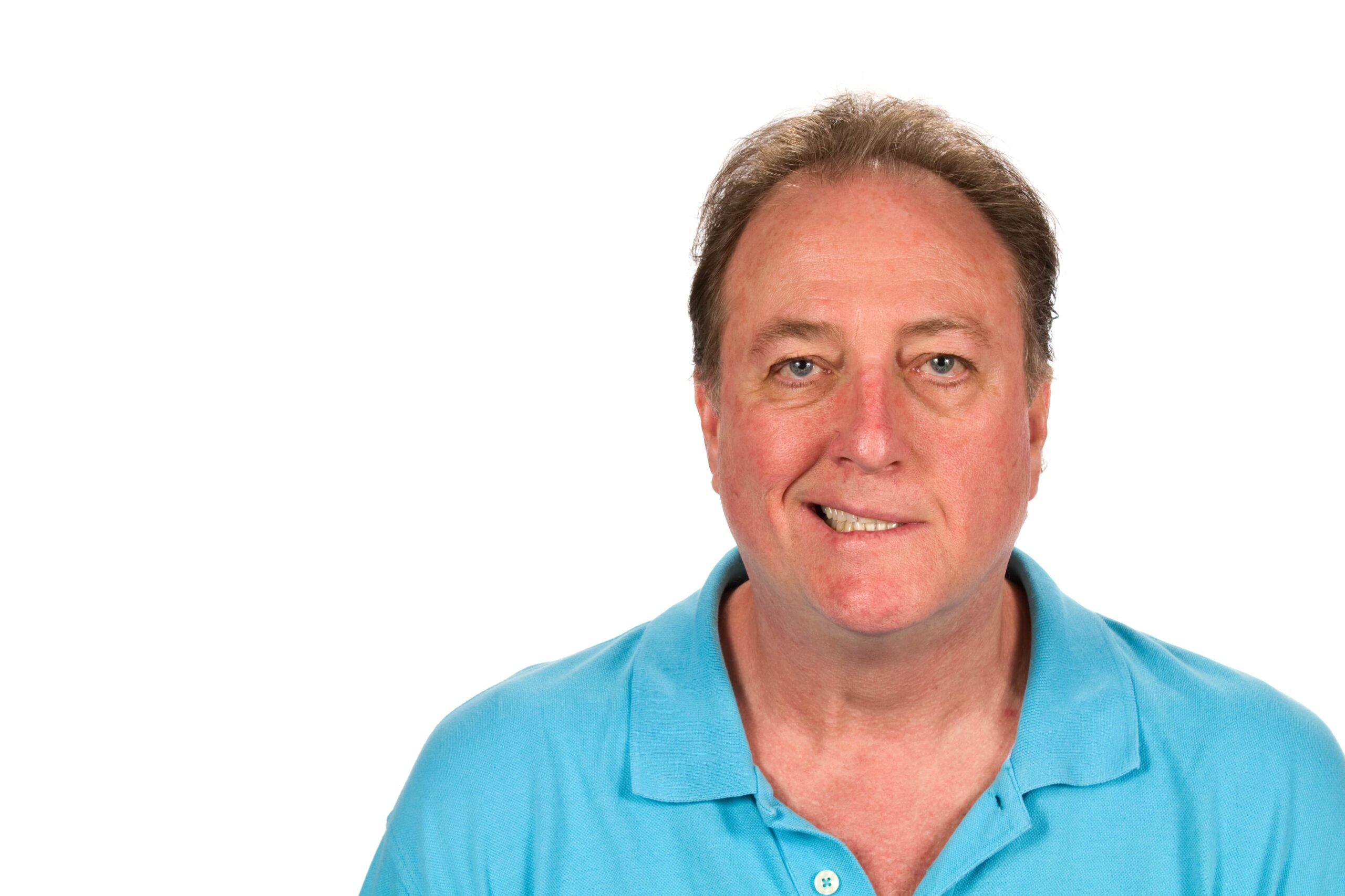 Mature man with Bell's palsy paralysis of facial the nerve.