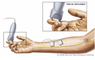hand nerve graphic with nerve stimulator