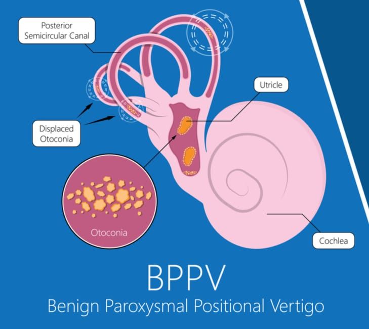 graphic of benign paroxysmal positional vertigo