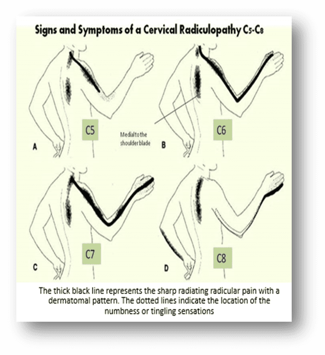 Cervical Radiculopathy Can Cause Neck Pain Stiffness And Neuropath