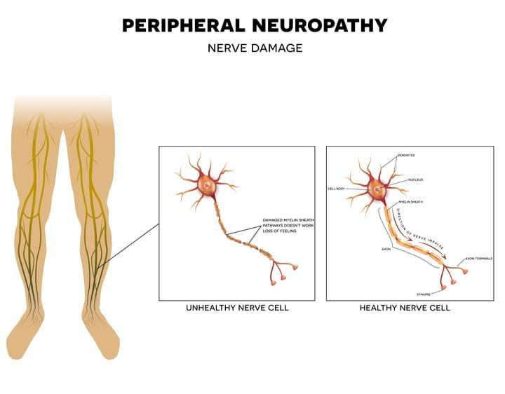 Peripheral Neuropathy Can Be Treated At Premier Neurology in Stuart, FL