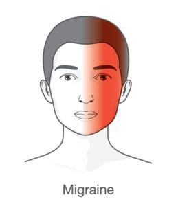 graphic of migraine affected area