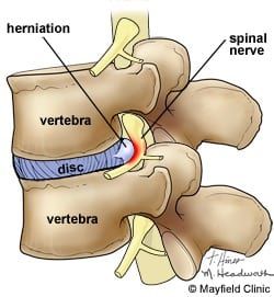 graphic of vertebra and spinal nerve