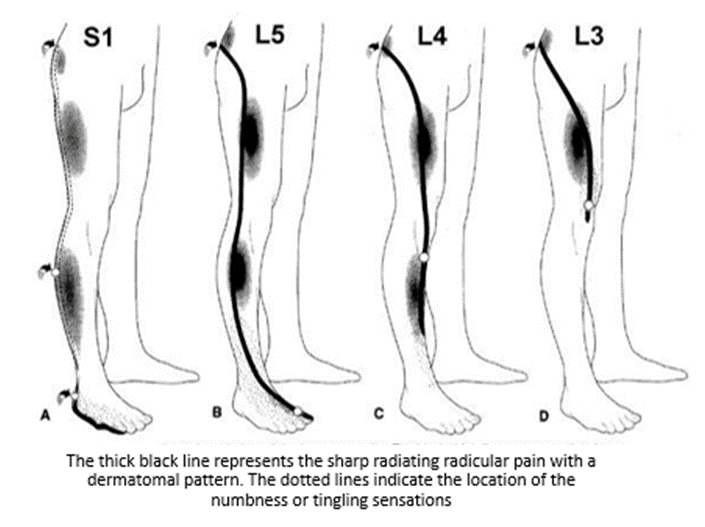 Get Relief From Lower Back Pain From Lumbrosacral Radiculopathy