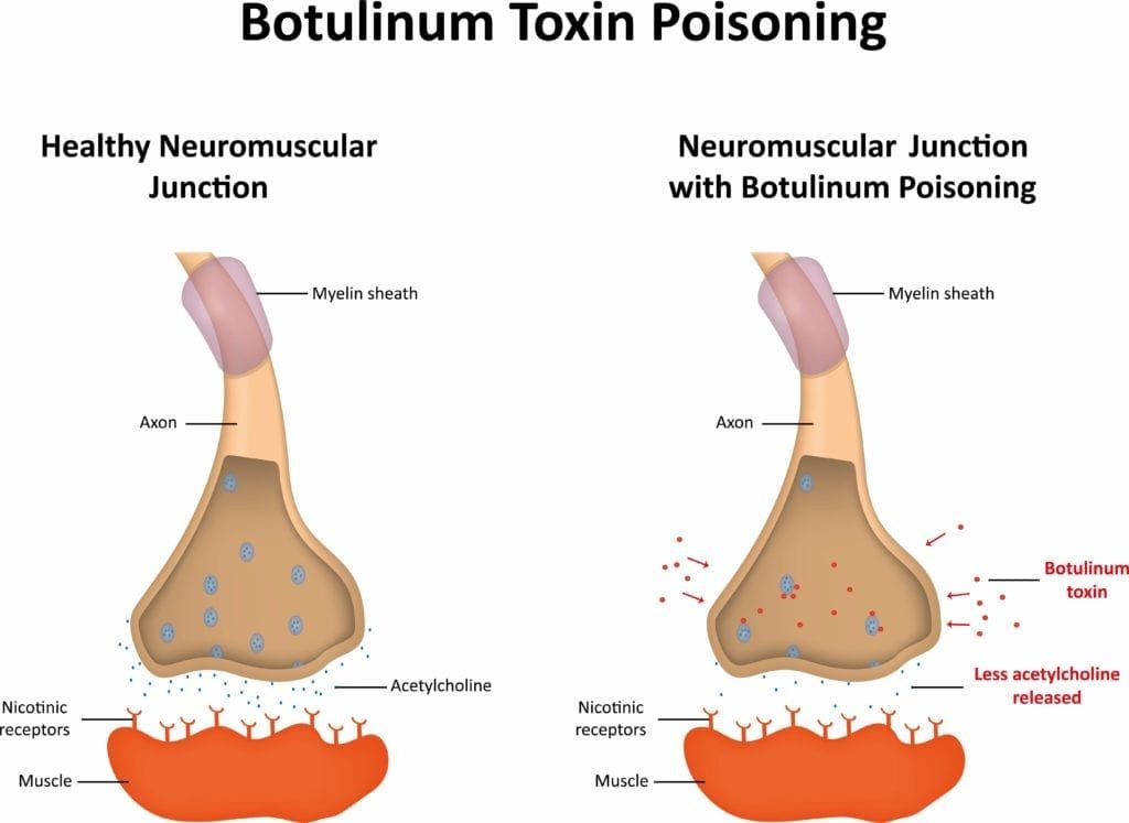 the effect of Botox on neuromuscular junctions