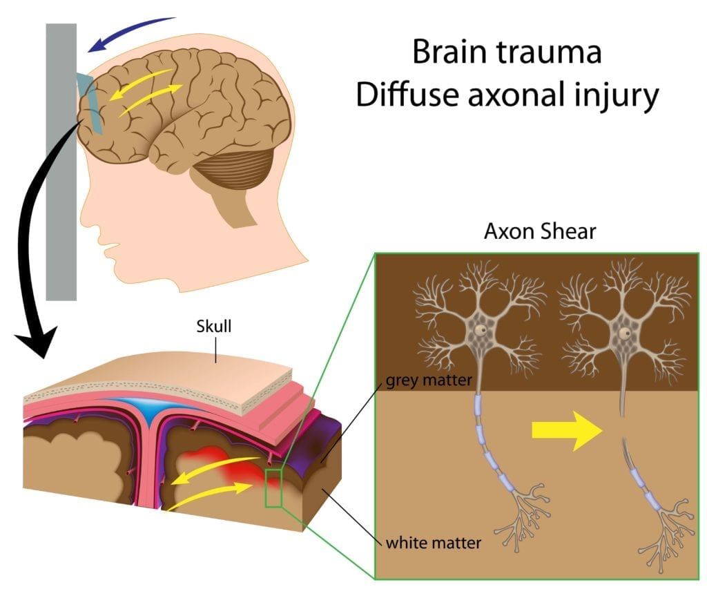 diagram on diffuse axonal injury