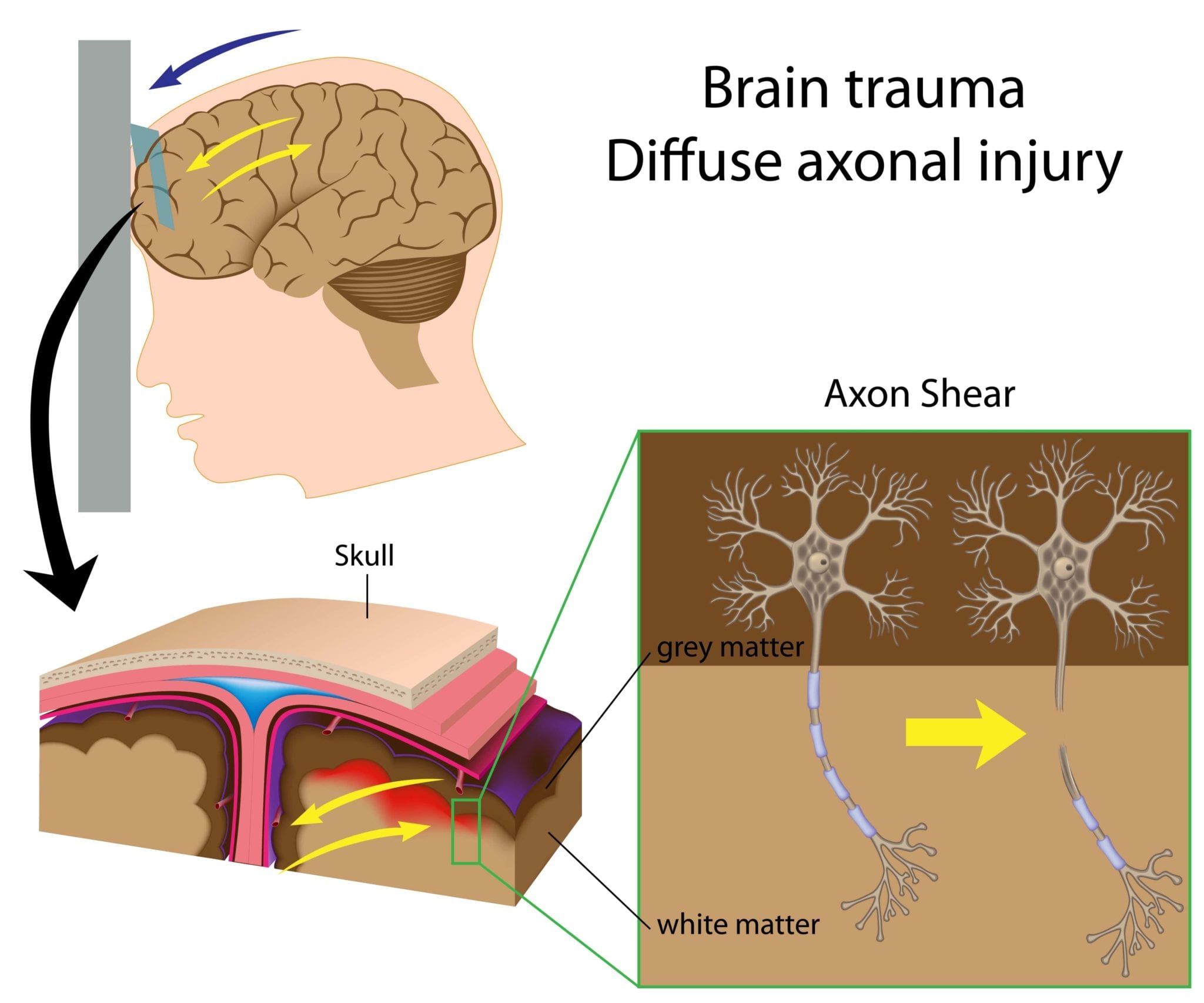 Механизмы черепно мозговой травмы