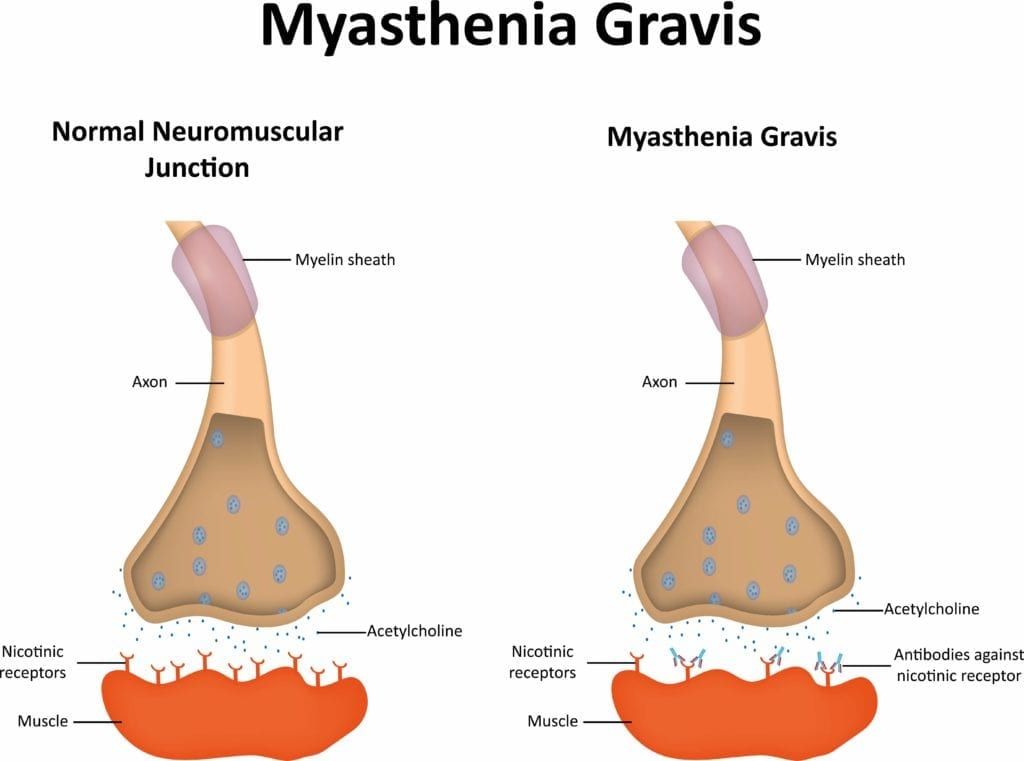 Shows a normal neuromuscular junction vs. one affected by myasthenia gravis