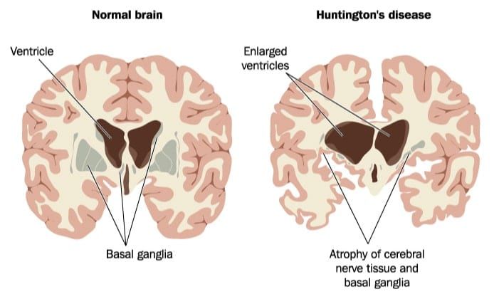 Huntington’s Disease (HD)