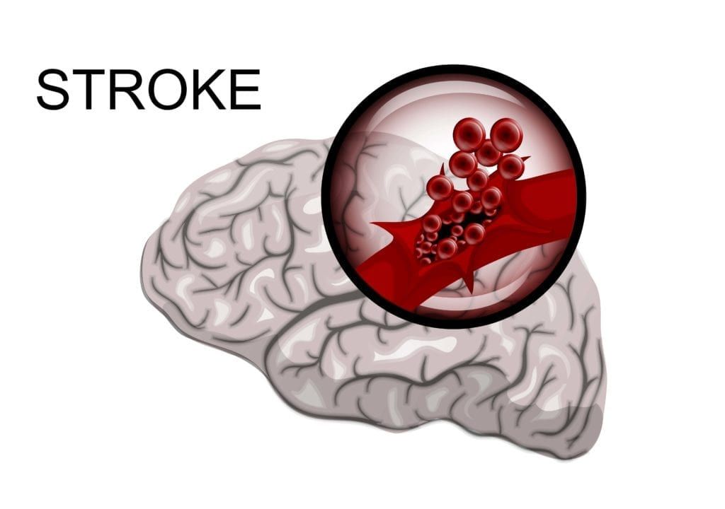 diagram of a stroke