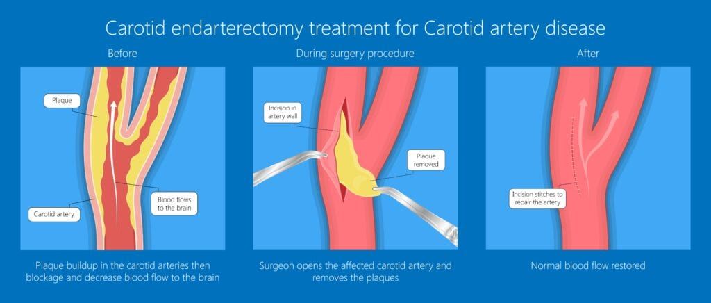 surgery for carotid artery disease