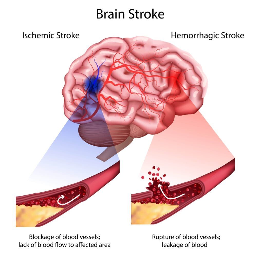 two main types of stroke: ischemic and hemorrhagic 