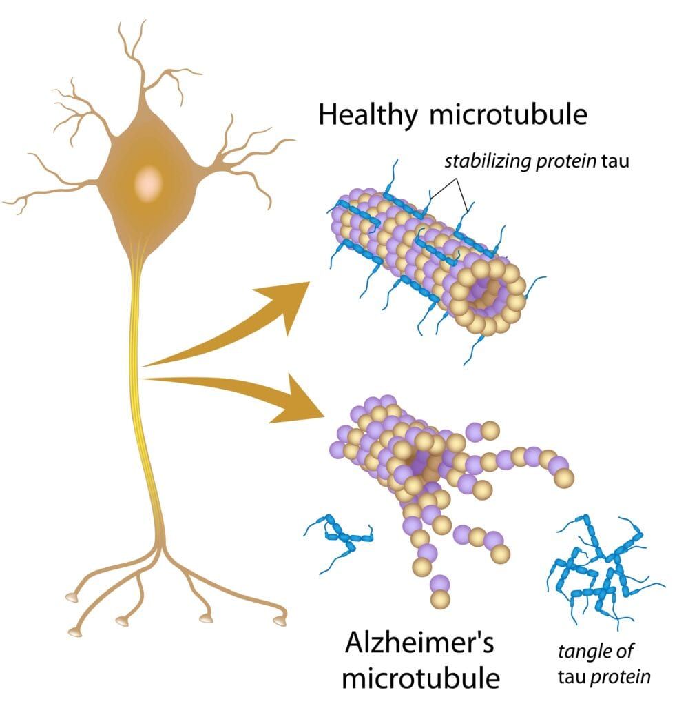 how tau protein tangles damage neurons