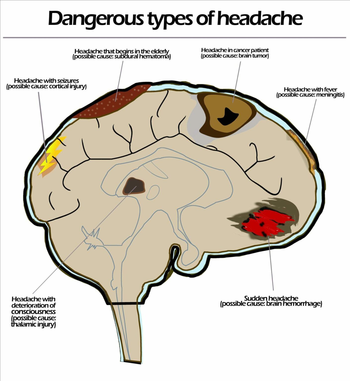 types-of-headaches-and-when-to-be-concerned-premier-neurology