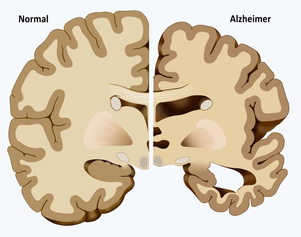 normal brain vs alzheimer's brain