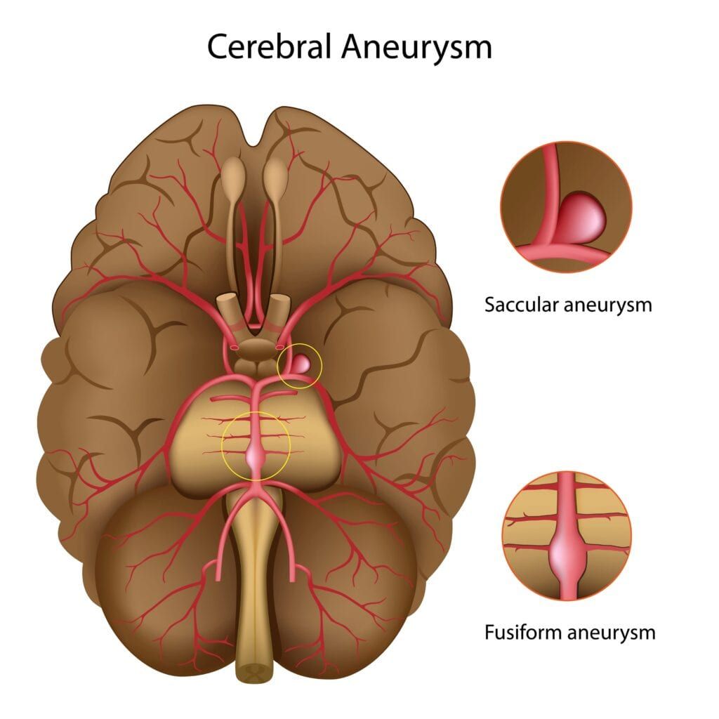 types of brain aneurysms