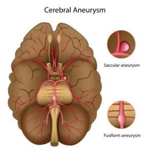 What You Need to Know About Brain Aneurysms - Premier Neurology ...