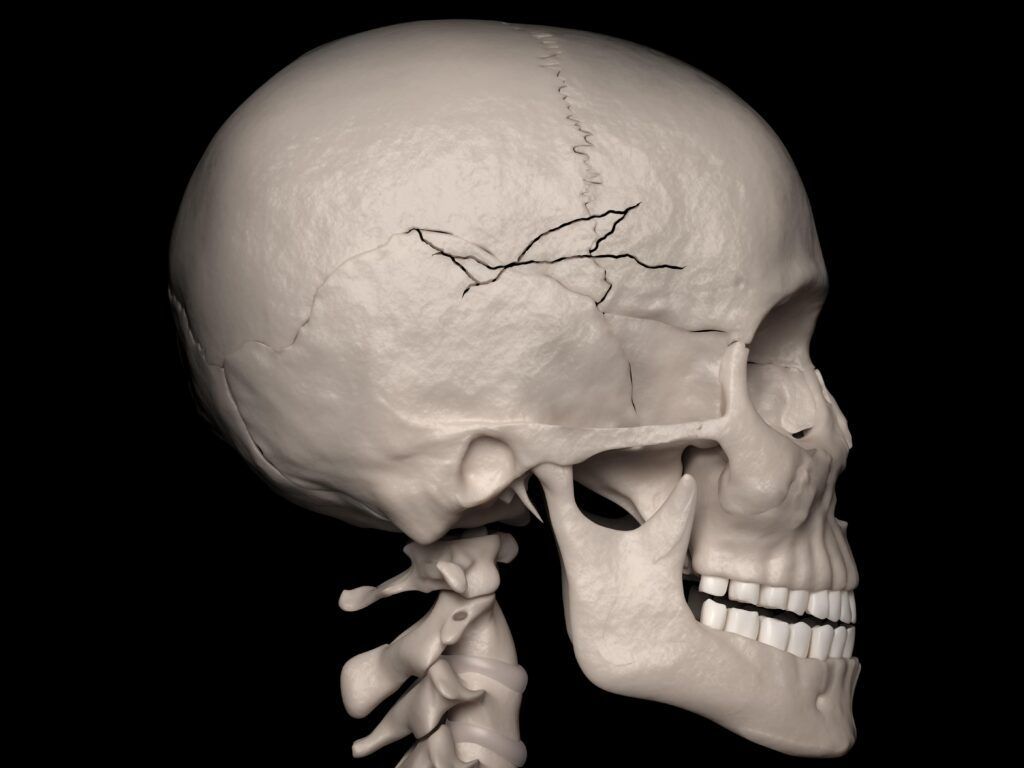 skull with fracture