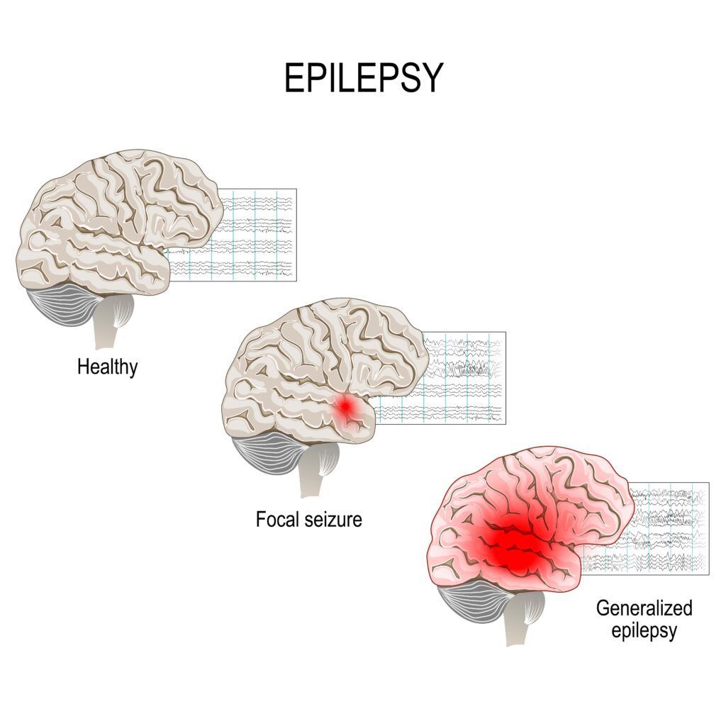 healthy brain vs epilepsy brain