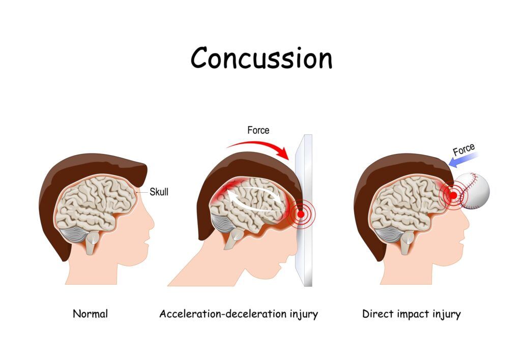 concussion diagram