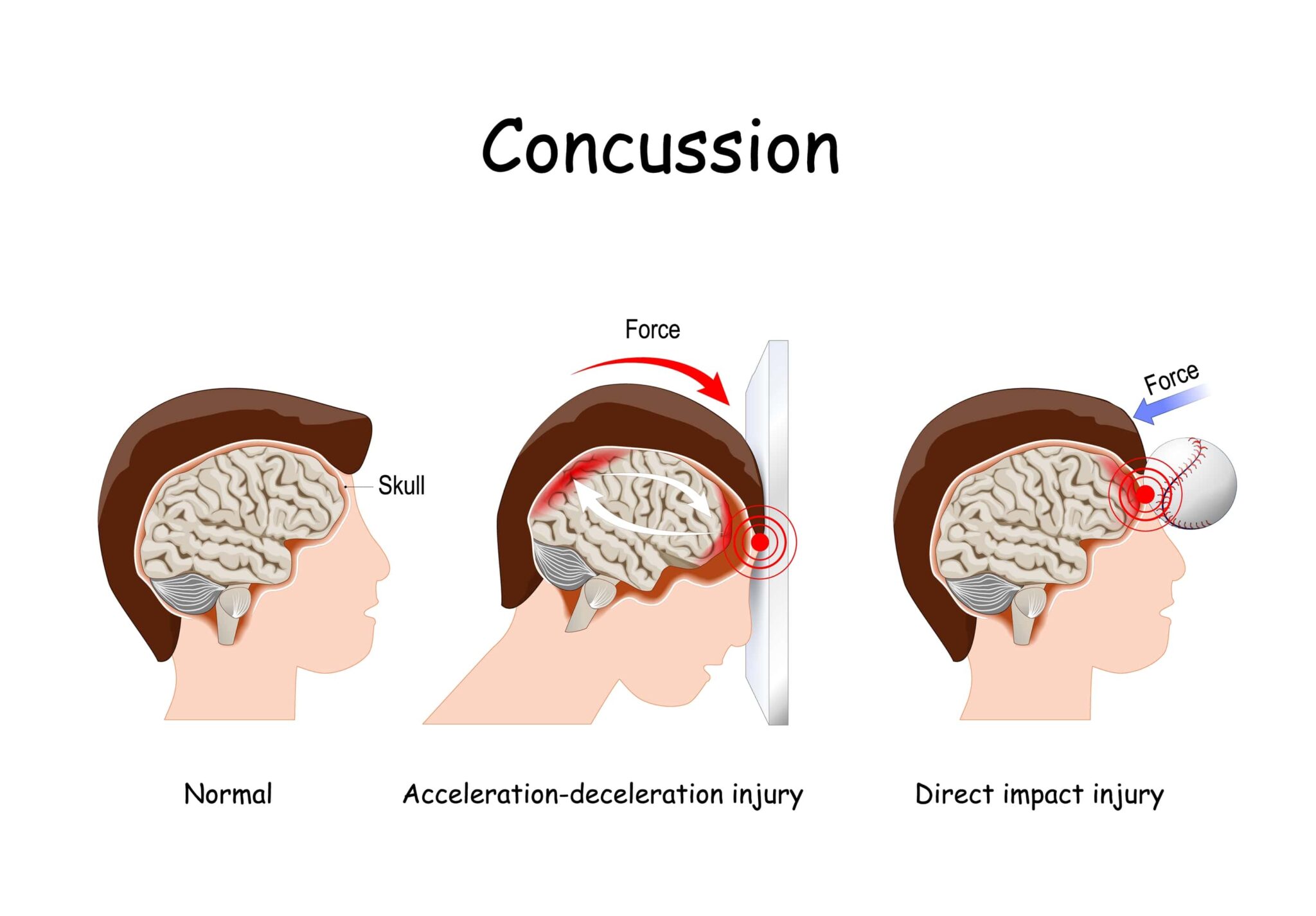 temporary amnesia from concussion