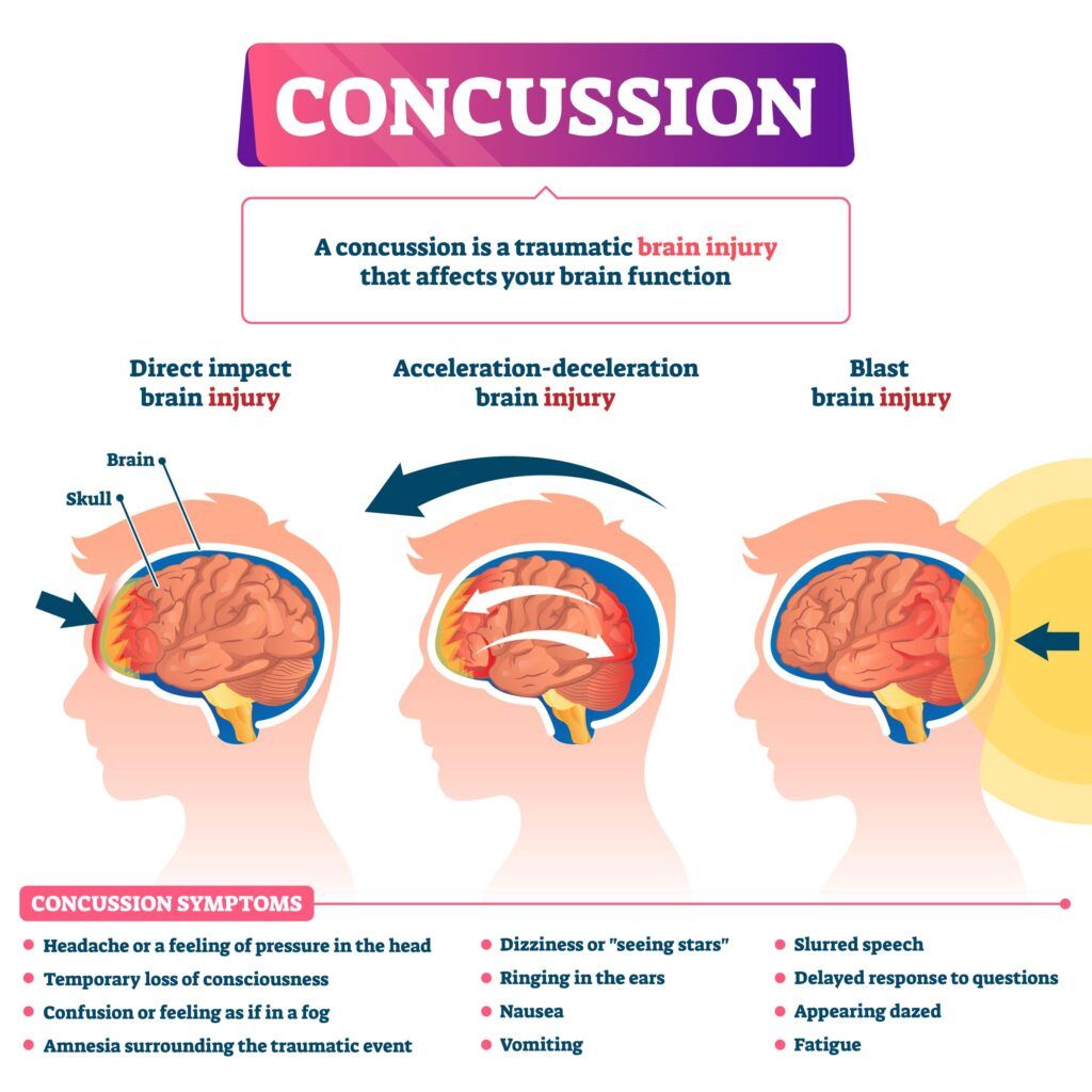 concussion infographic