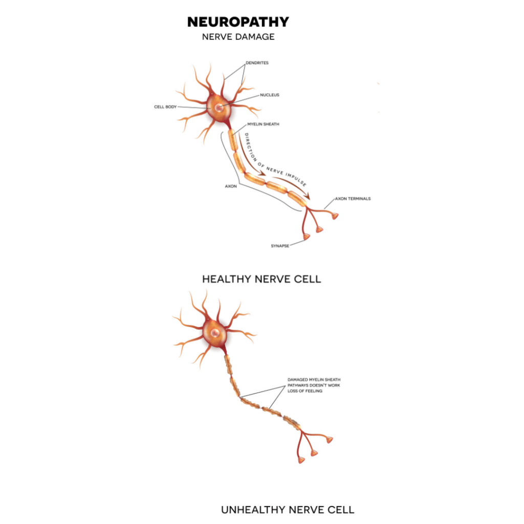 healthy nerve vs damaged nerve