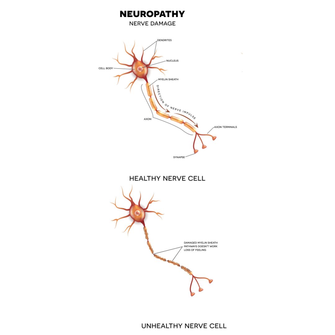 what-are-the-most-common-causes-of-nerve-damage-premier-neurology