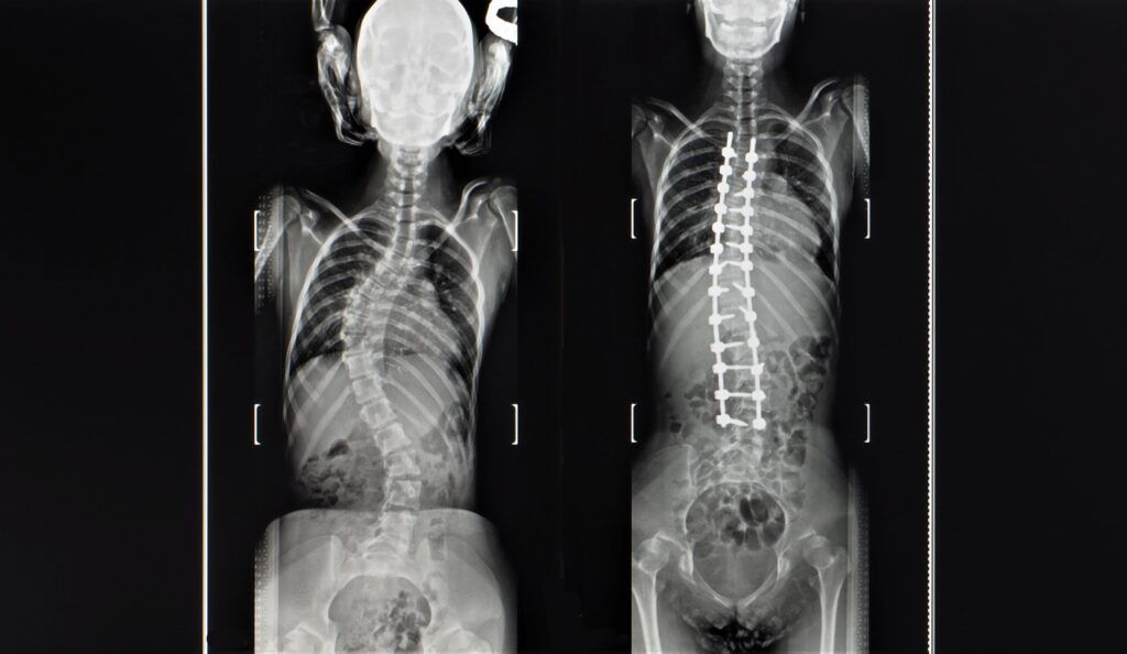 spine with scoliosis before and after surgery