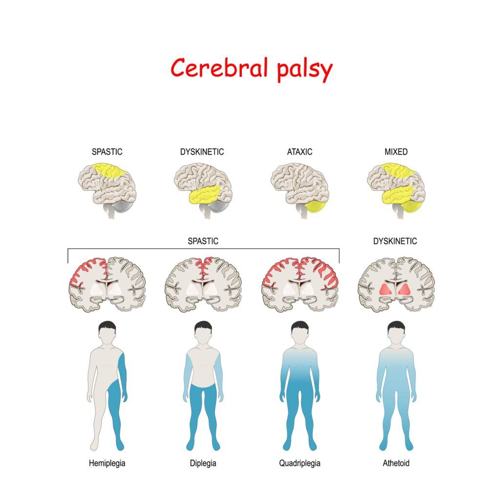 types of cerebral palsy