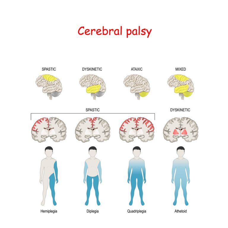 What is Cerebral Palsy? - Premier Neurology & Wellness Center