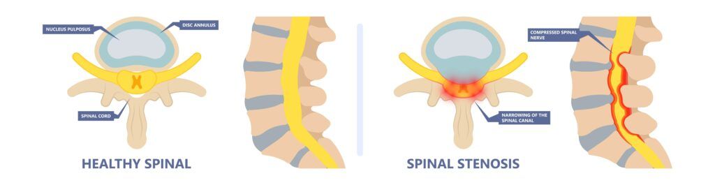 compressed spinal nerve from spinal stenosis