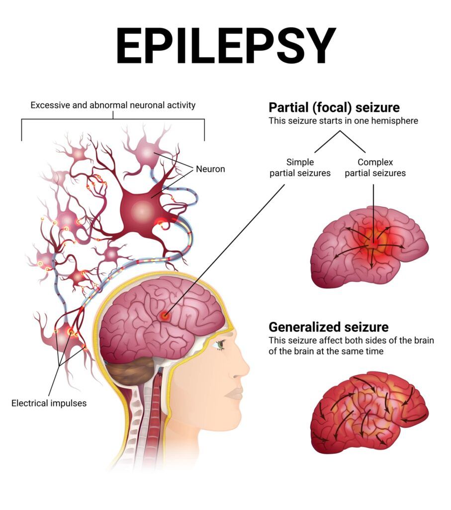 neurological disorders, epilepsy, generalized and partial epileptic seizure, sectional brain and neurons, medical illustration
