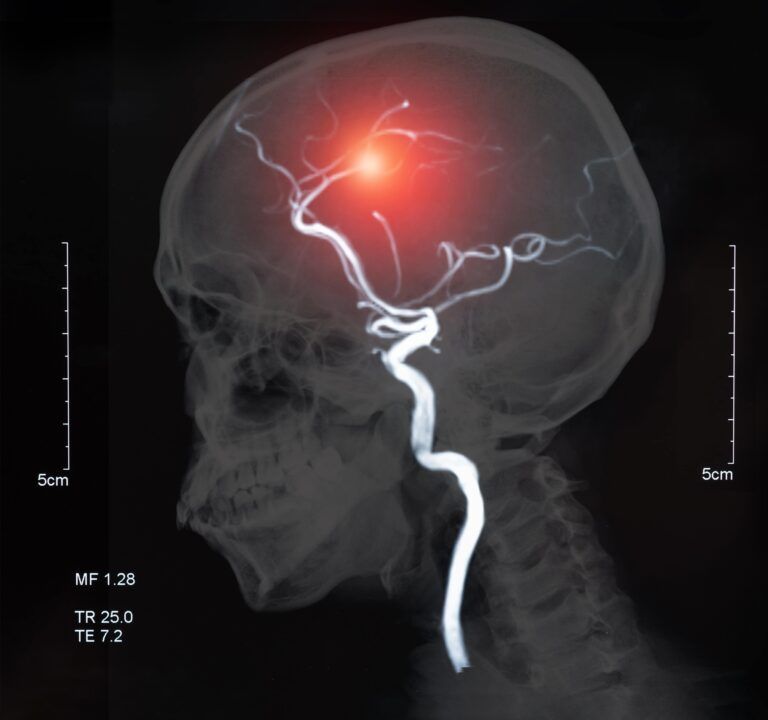 brain aneurysm and/or hemorrhagic stroke